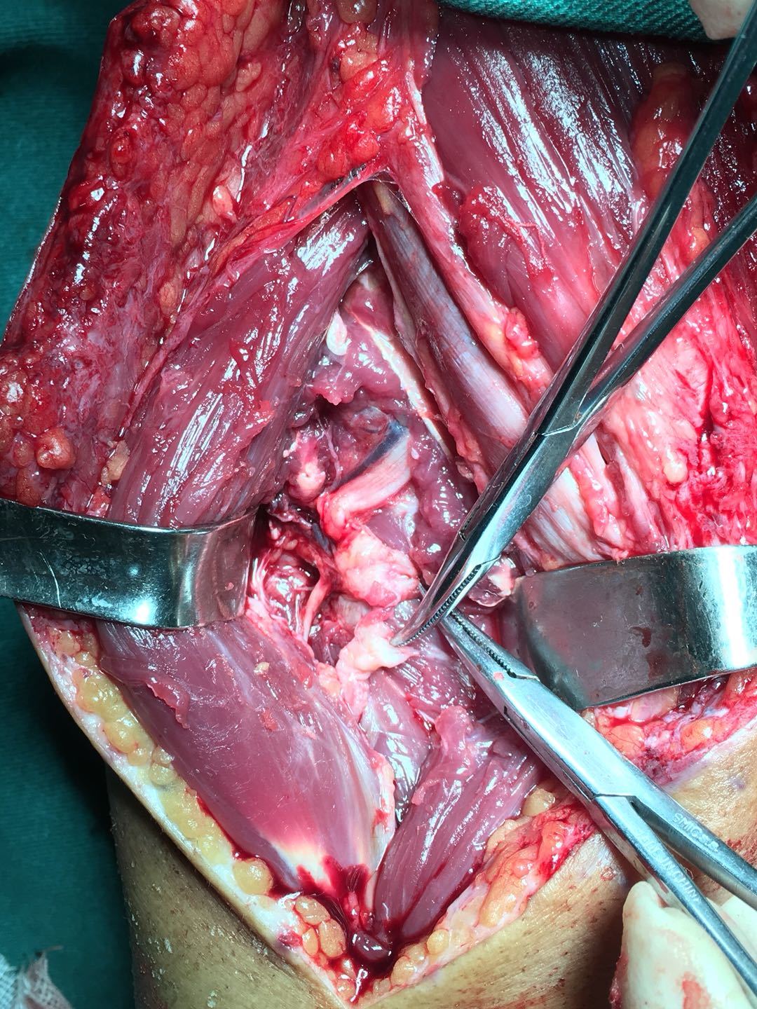 显微镜下神经吻合副神经断裂肌电图