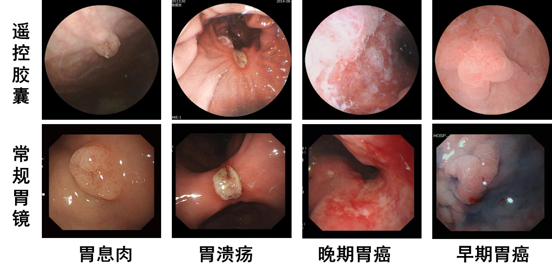 什么情况下做胶囊内镜检查