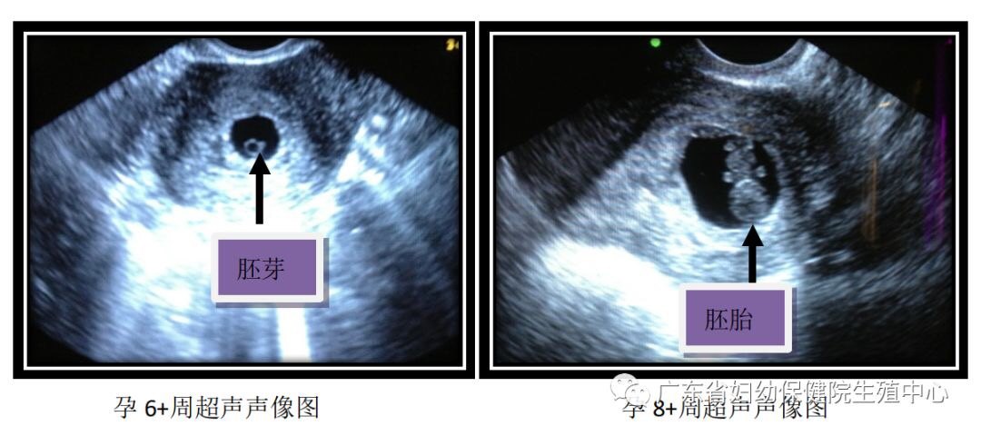 早孕超声解读