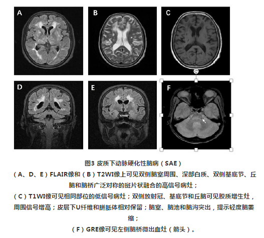 皮质下动脉硬化性脑病(sae)也称为binswanger病或小血管性痴呆,临床