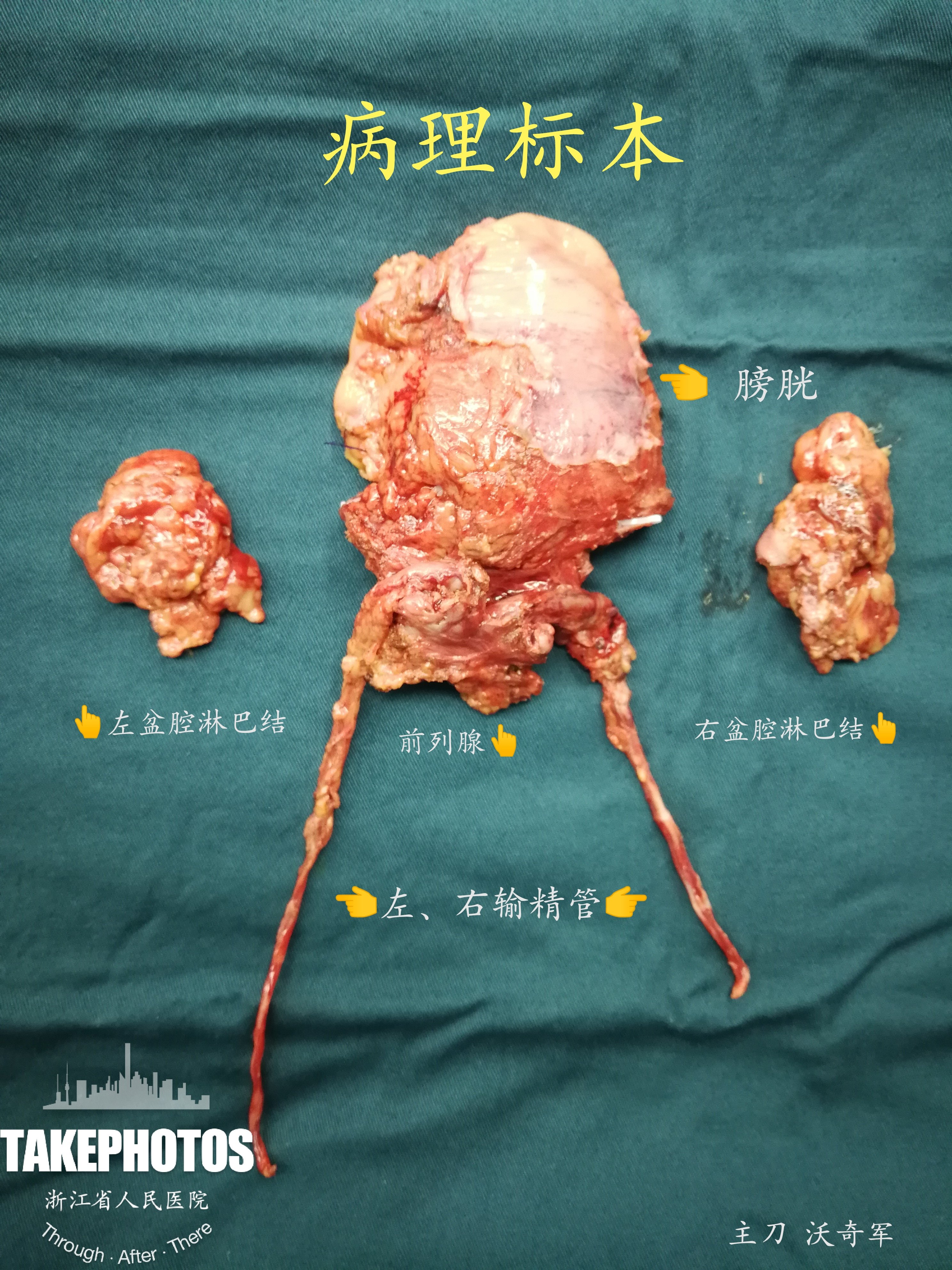 出院宣教:(机器人)腹腔镜膀胱癌根治术 bricker - 好大夫在线