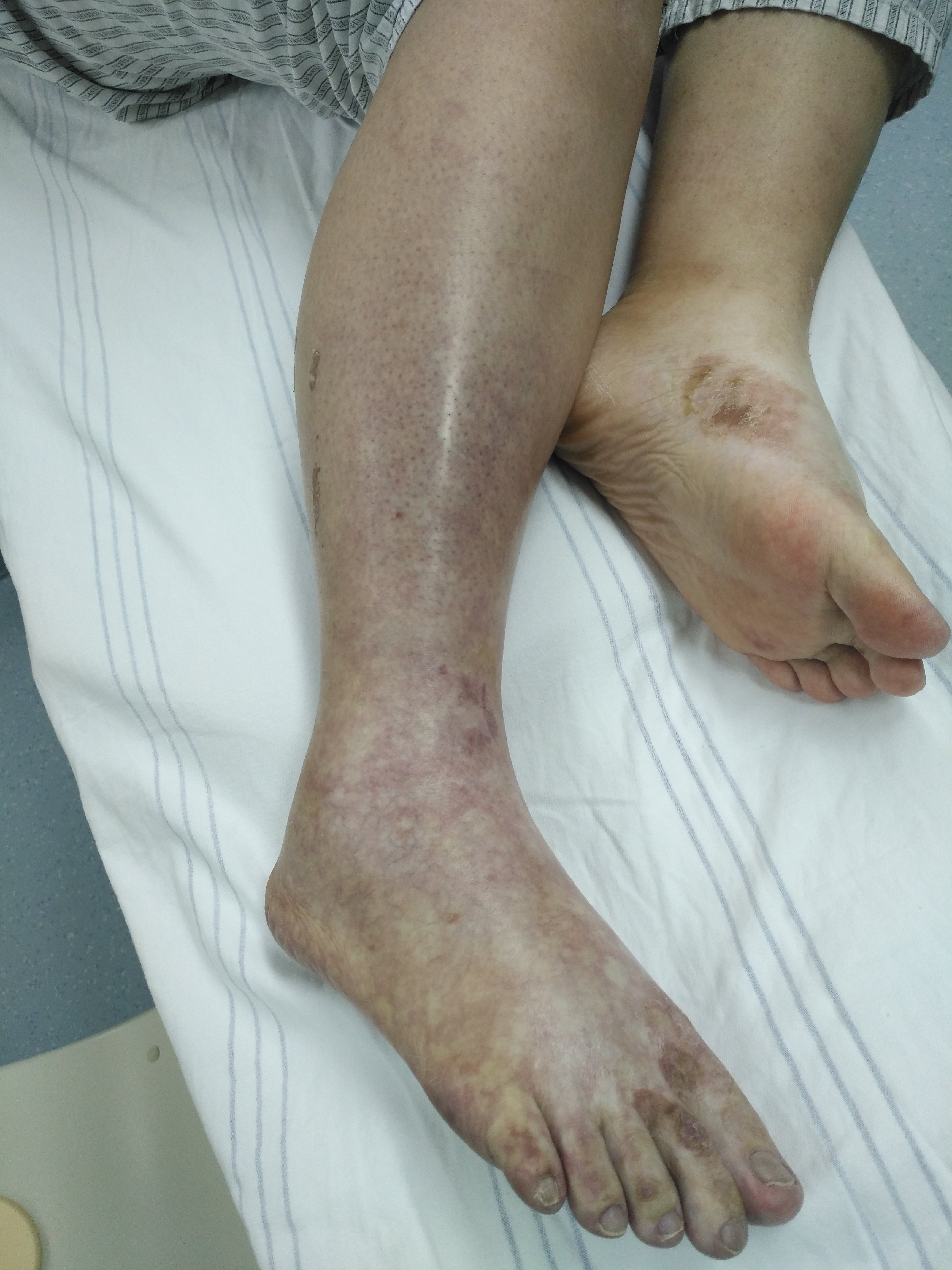 浅动脉复通取栓后腘动脉及膝下动脉复通取出的血栓取栓后患肢得以存活