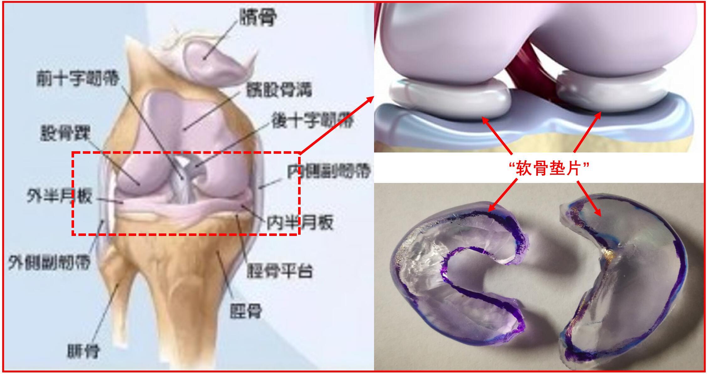 半月板损伤 别担心 张大夫教你怎么办 膝关节半月板损伤 半月板损伤 别担心 张大夫教你怎么办 膝关节半月板损伤