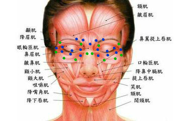 眼睑痉挛治疗的肉毒素注射位置