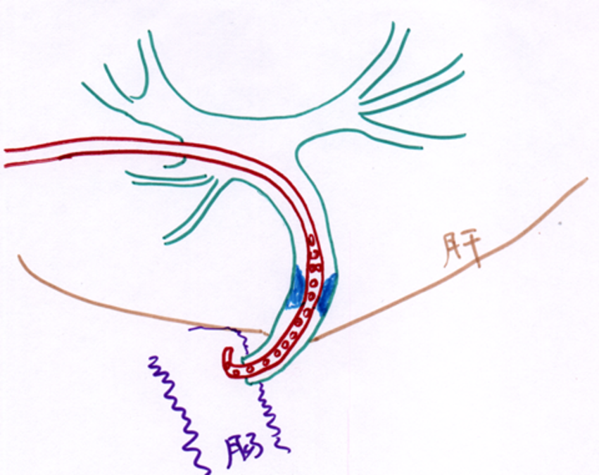 梗阻性黄疸的介入诊疗