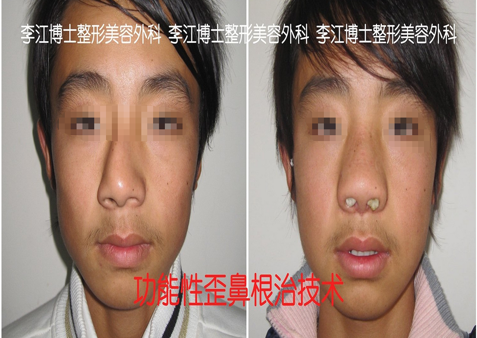 歪鼻畸形、功能性歪鼻整形技术、歪鼻美容