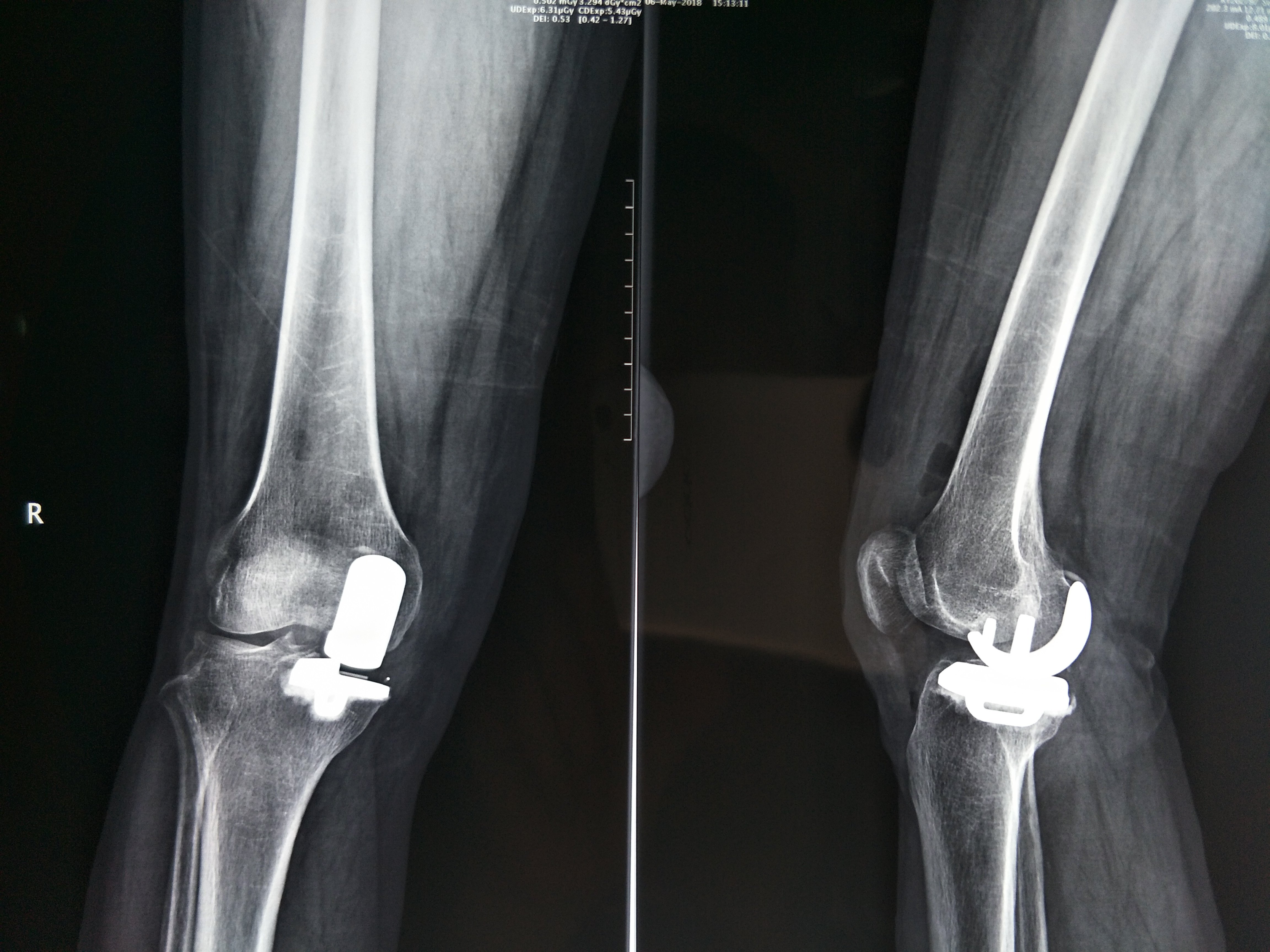 膝关节骨性关节炎单髁置换术 
