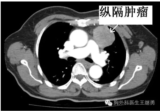 胸腺瘤,纵隔肿瘤怎么办? - 好大夫在线