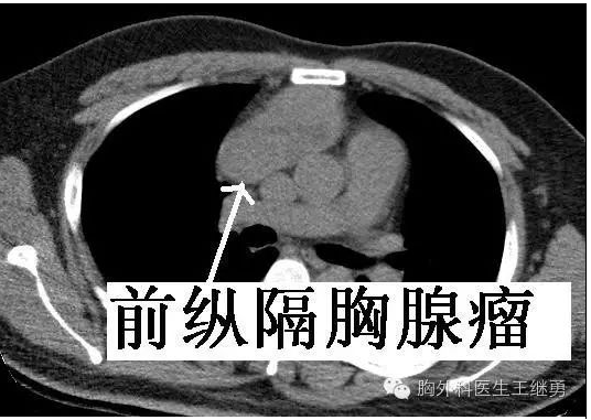 胸腺瘤症状图片