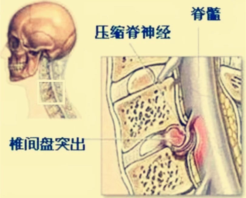 只知道腰椎间盘突出 那你知道颈椎间盘也会突出吗