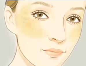 激光术后色素沉着和返黑怎么办 激光术后色素沉着和返黑怎么办