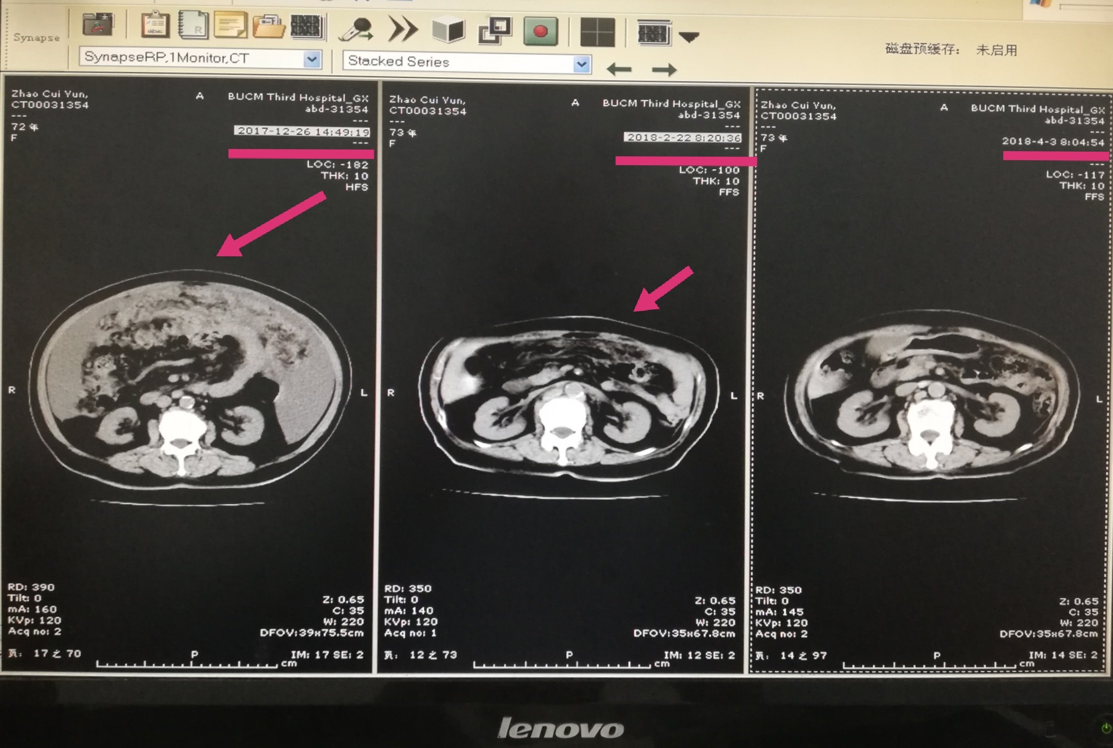 中西医治疗老年晚期卵巢癌至肿瘤影像消失并成功手术1例分享