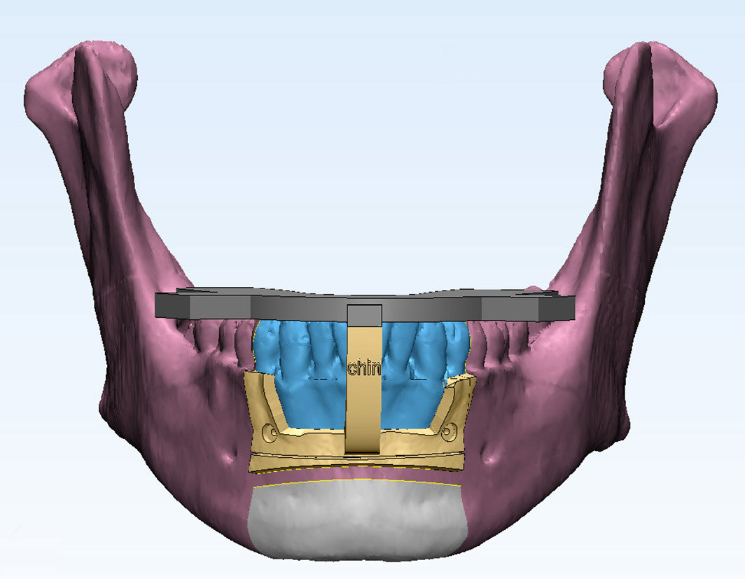 突嘴需要手术吗?