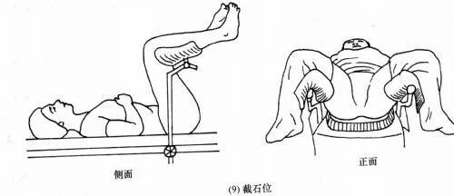 我们需要先花一点篇幅了解一下妇科检查时的体位—膀胱截石位