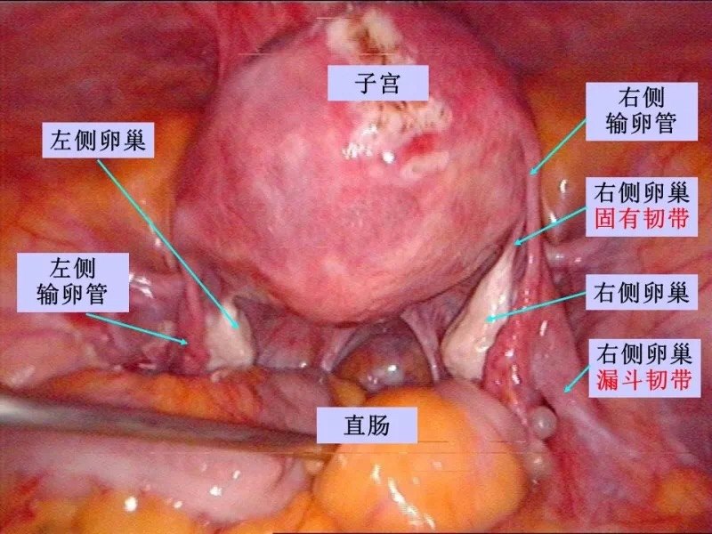 卵巢冠解剖图片