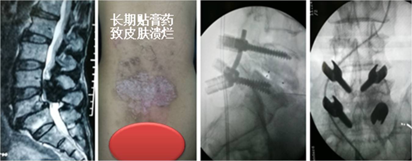 腰椎退行性失稳与滑脱 好大夫在线 腰椎退行性失稳与滑脱 好大夫在线