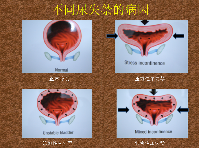 尿失禁分类图片