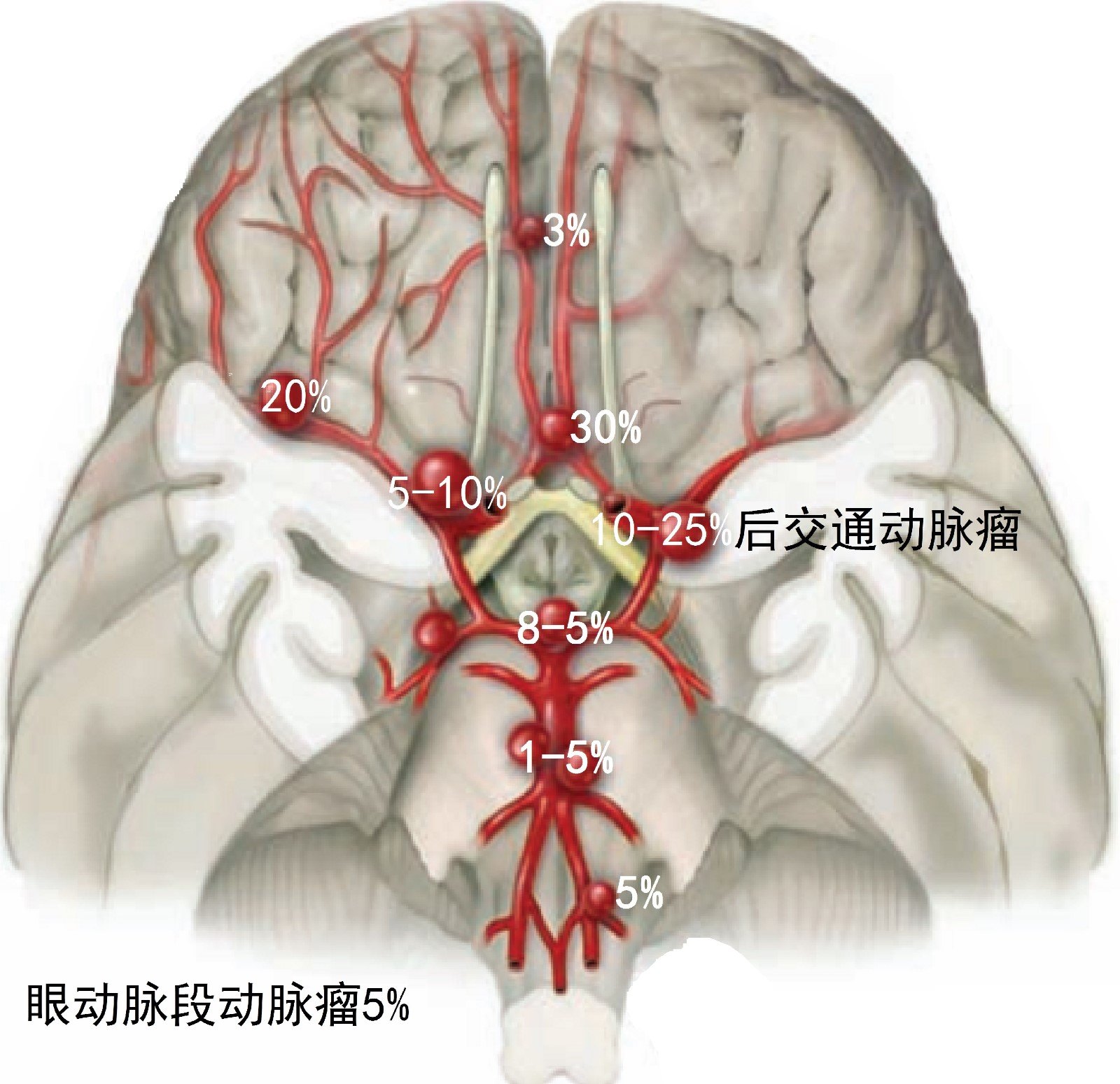 颅内动脉狭窄治疗_颅内脊索瘤手术_动脉脑瘤手术后能活多久