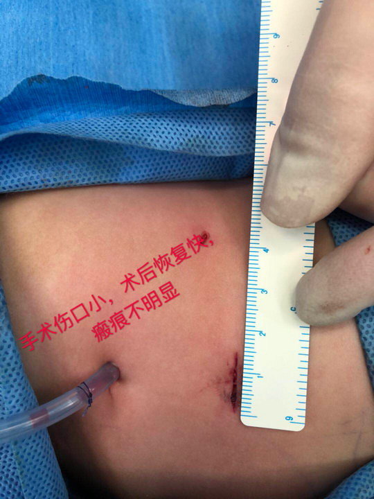 华南地区首例3月龄小儿经腹膜后入路腹腔镜肾囊肿去顶减压术 