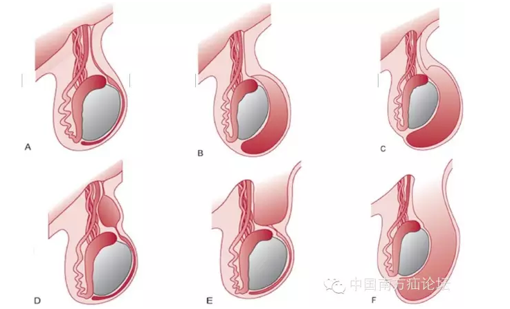 小儿疝气科普 - 好大夫在线