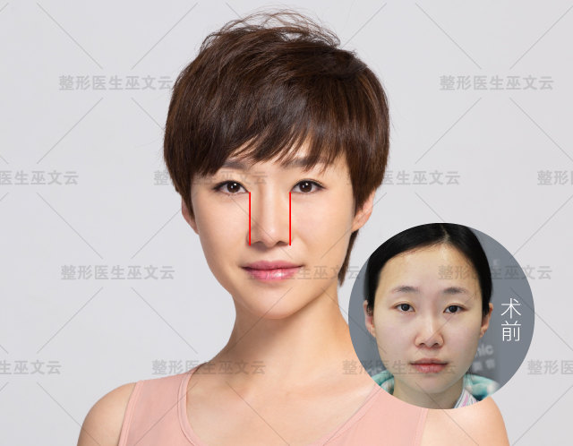 鼻翼缩窄-02.jpg