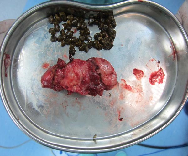 复杂胆囊切除手术 - 好大夫在线