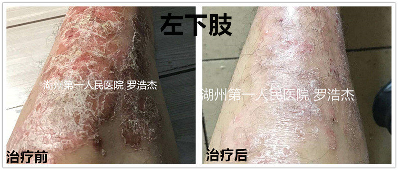 中醫中藥治療在銀屑病牛皮癬治療上的臨床案例