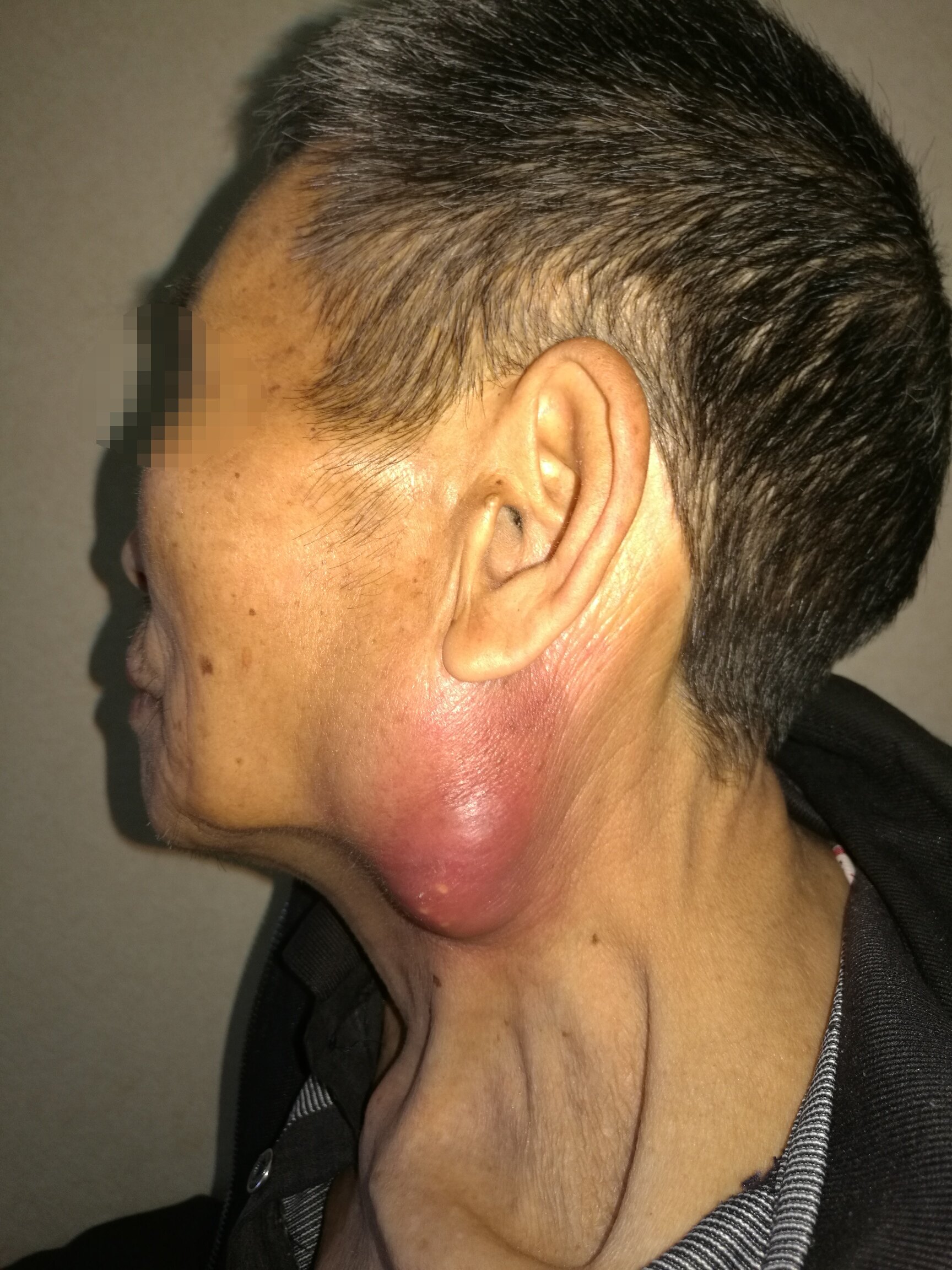 腮腺混合瘤症状图片图片