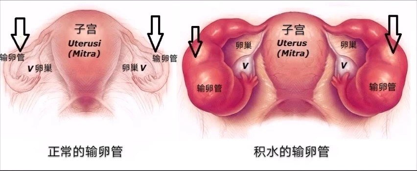 为什么试管前需要处理输卵管积水?-6