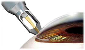 眼角膜在眼睛哪个地方 vIYBAFseNJ-AQv8LAADSxlg3ZdM101.png?_ms_=bfb4