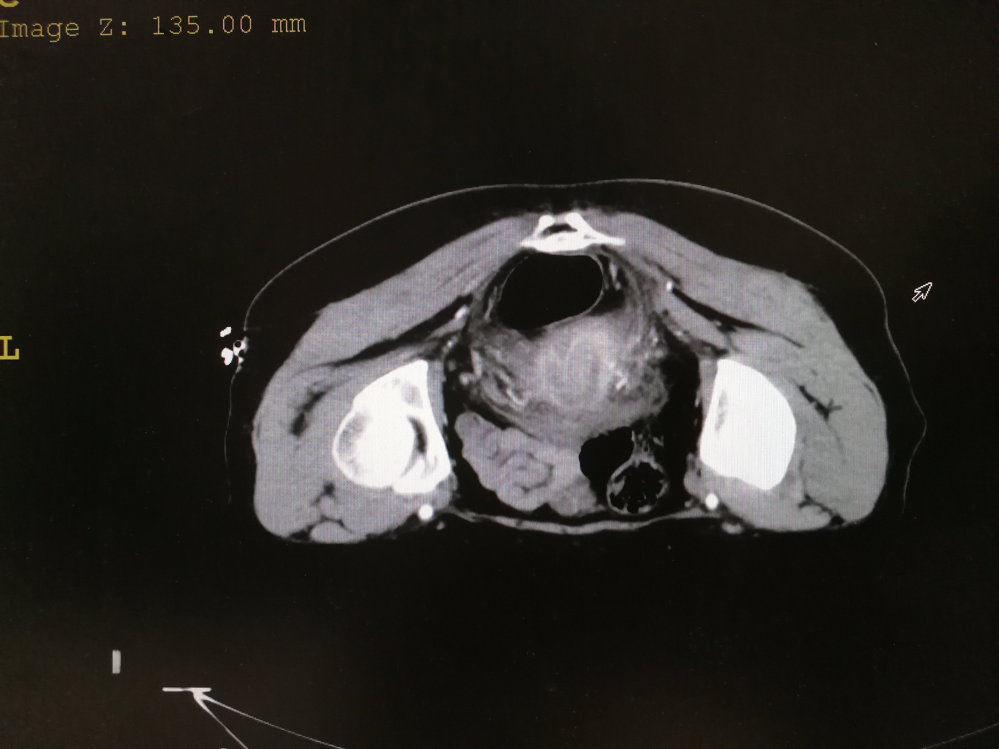 子宫颈占位穿刺活检 - 好大夫在线
