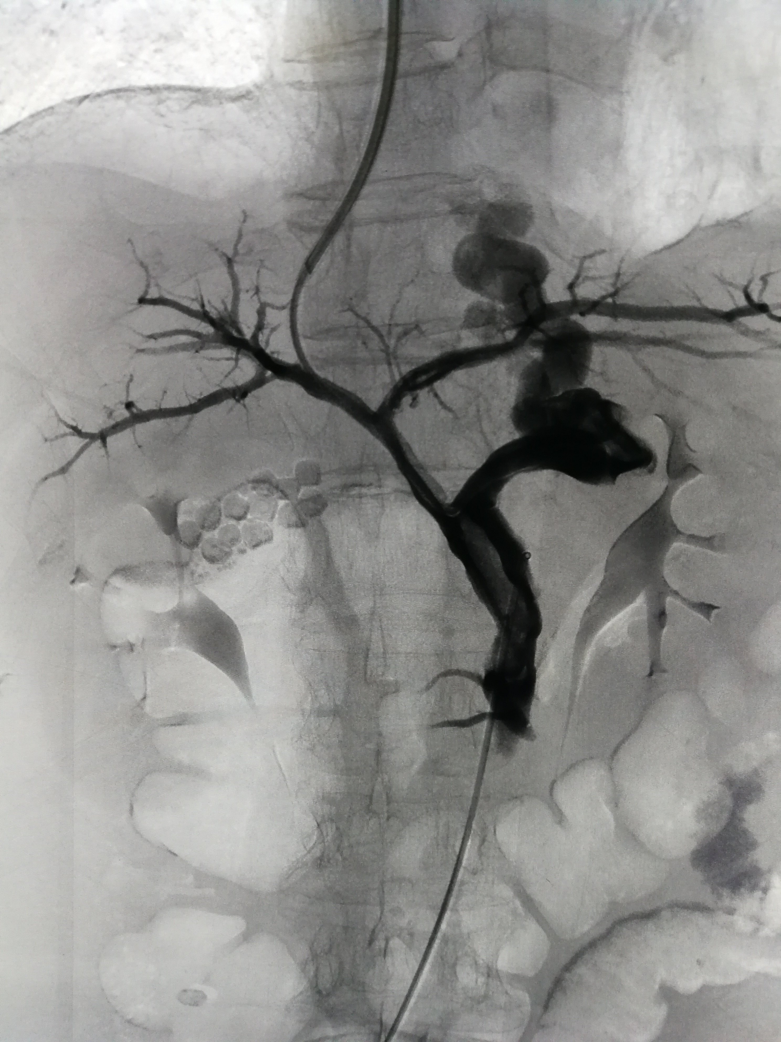 肝硬化门静脉高压消化道出血