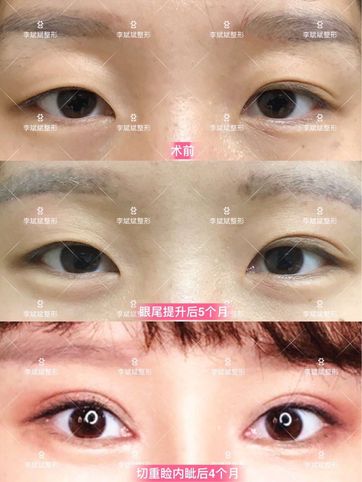 手术用时约1小时,基础恢复1-2周,恢复自然3-6个月.