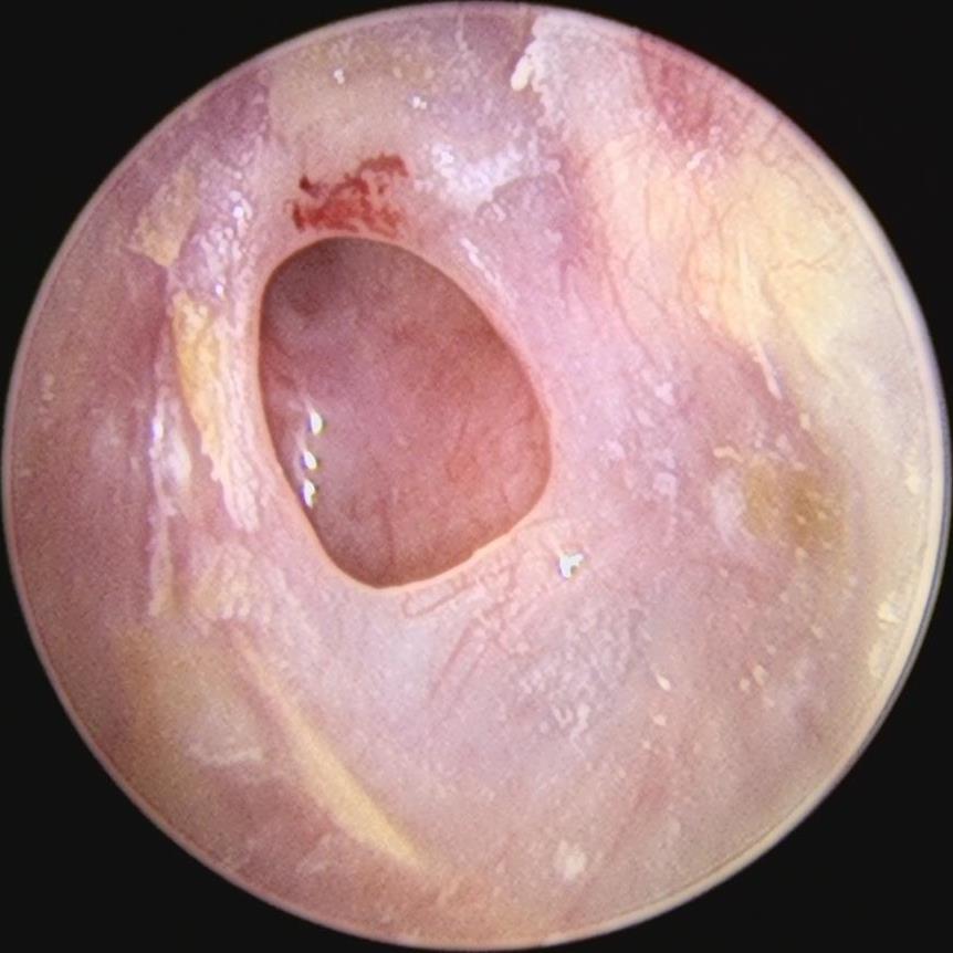 中耳炎脓性分泌物图片图片