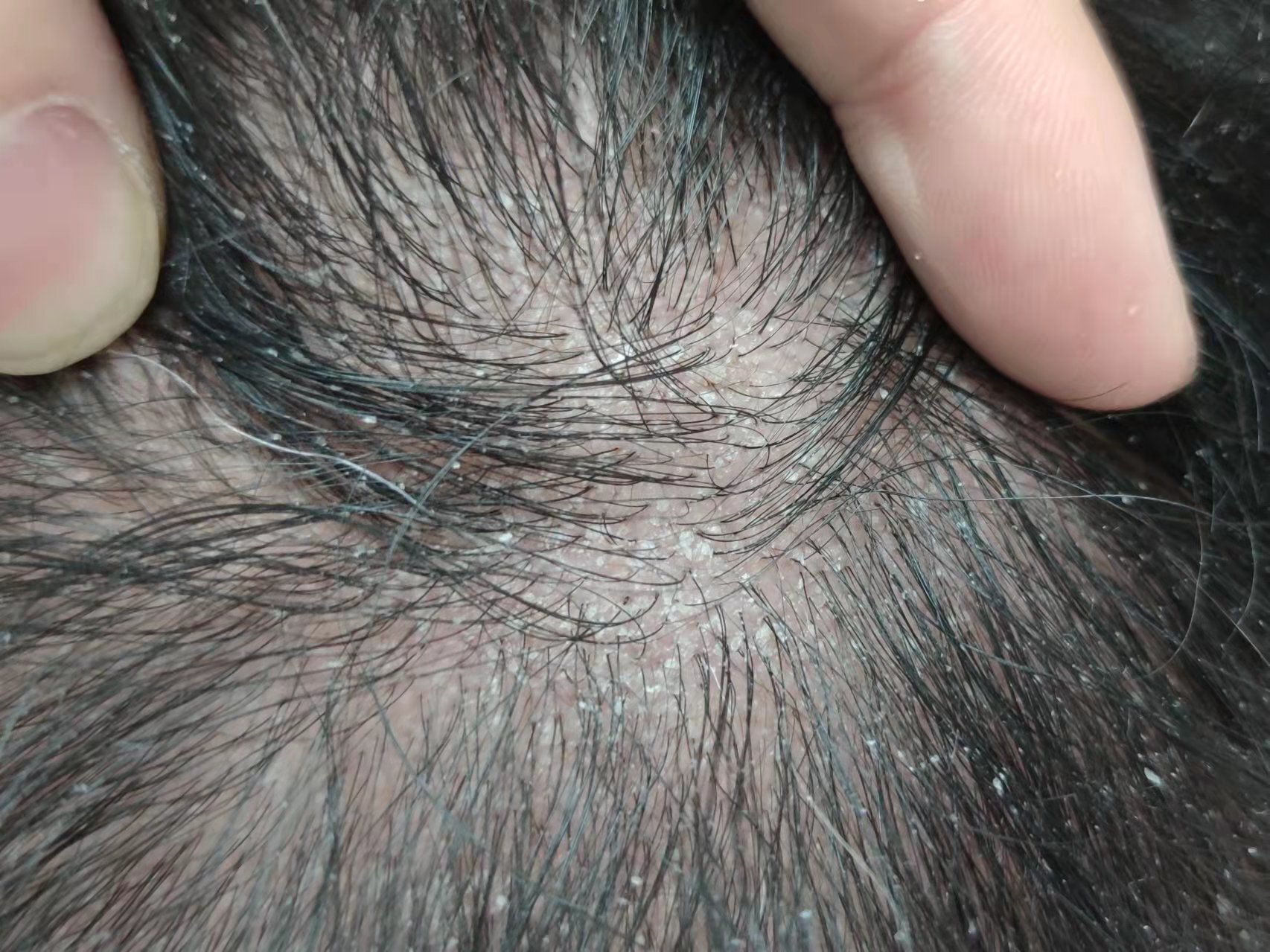 头皮油,头屑多,头皮痒——头皮脂溢性皮炎是怎么回事?_脂溢性皮炎 - 好大夫在线