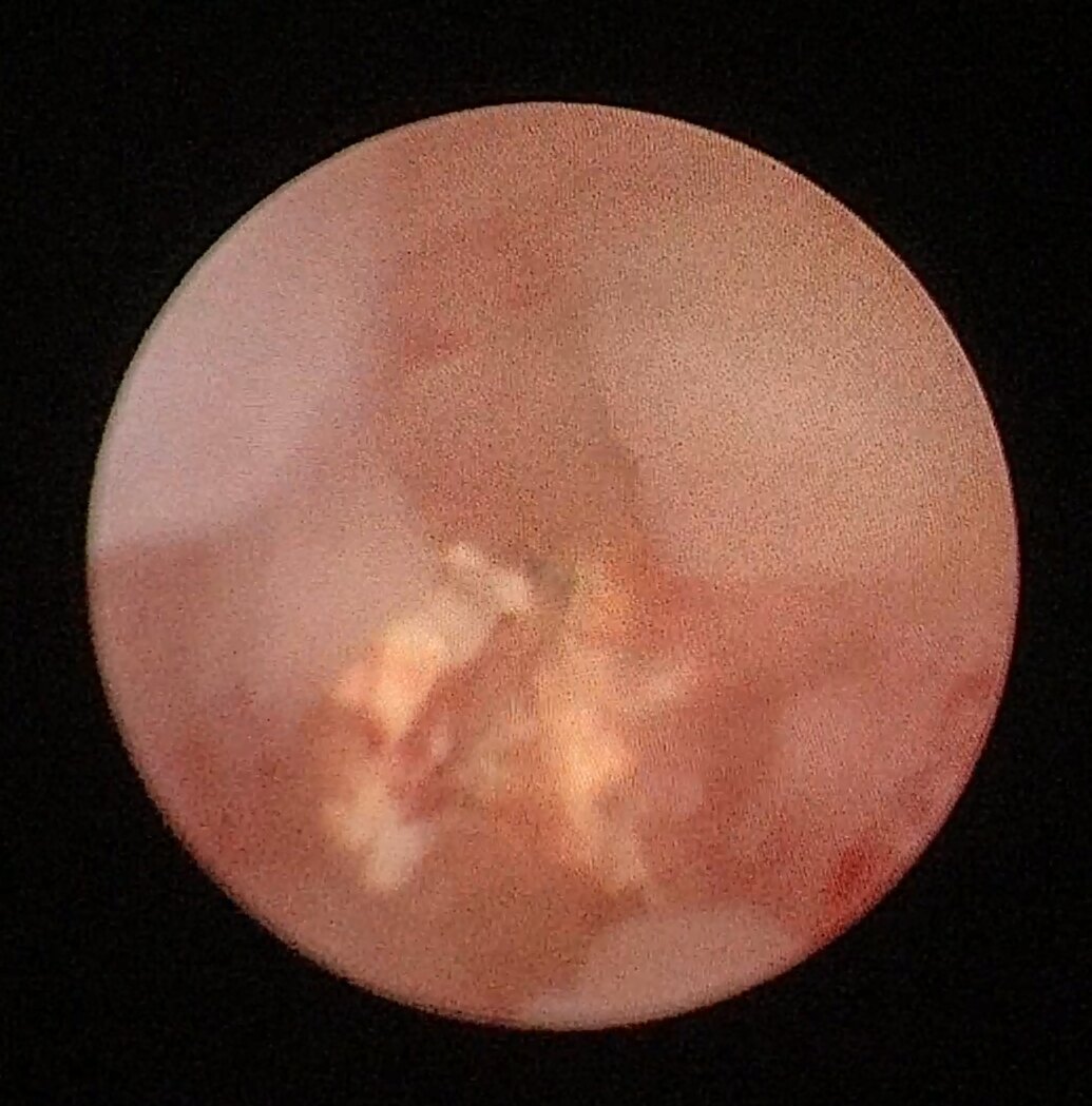 输尿管管腔狭窄闭锁,纤细的导丝导管无法通过结石引起的息肉和输尿管