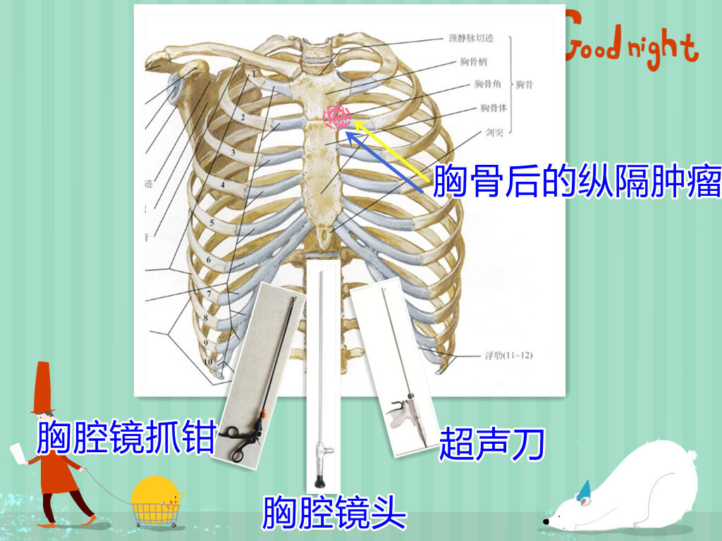 就是說,通過劍突下的腹壁製作小孔,從劍突的下面向胸骨後面逐漸遊離