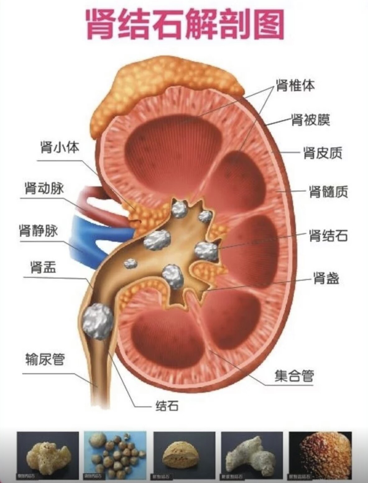 肾结石是怎么样来的 1IYBAGH5GAGAZrRhAAK_6a8CoPo302.jpg?_ms_=3ef8