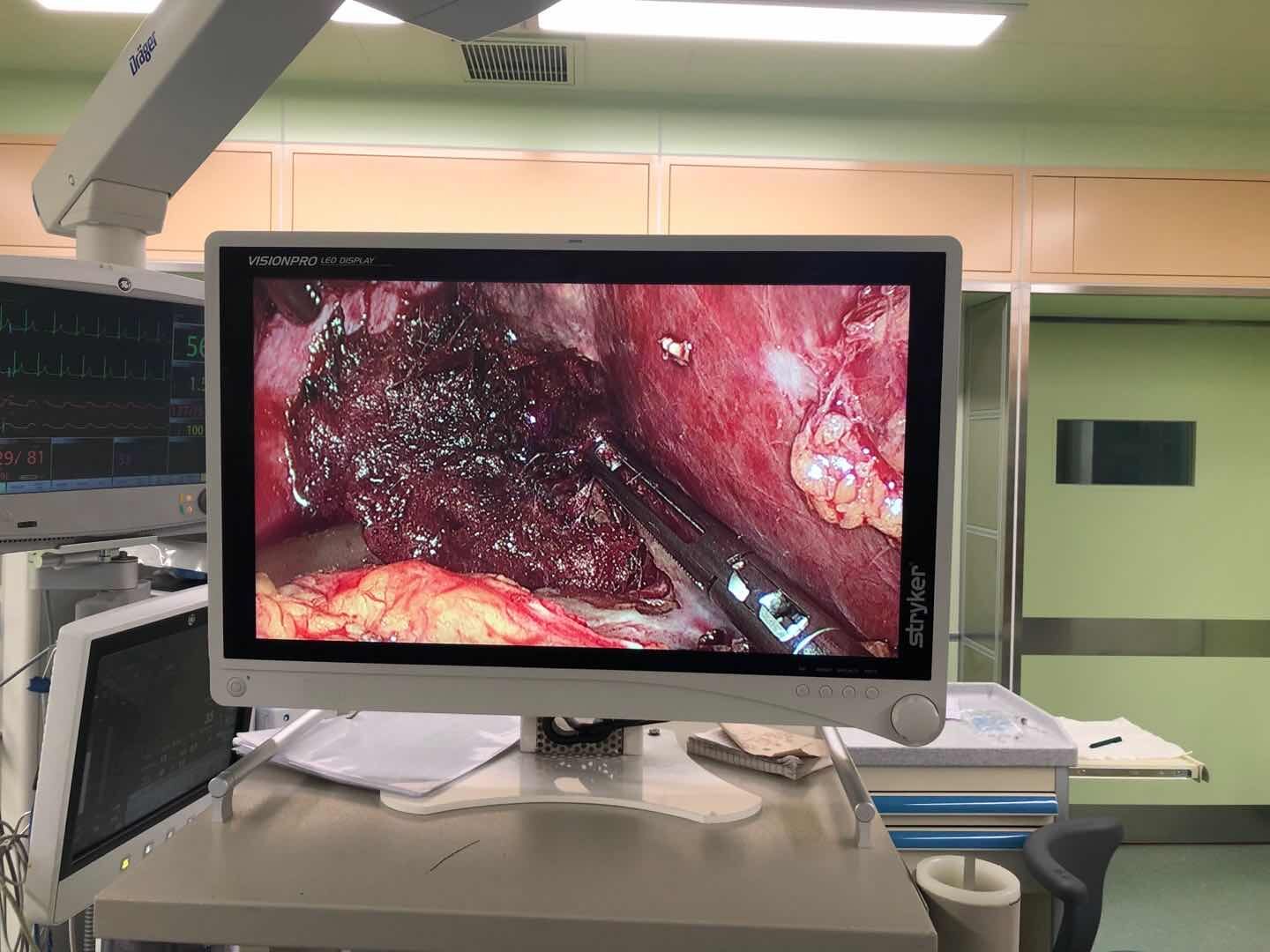 腹腔镜肝切除治疗转移性肝癌术后复发_肝癌_肝癌治疗方式 - 好大夫