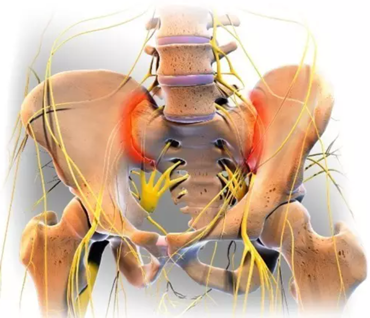 骶髂關節顧名思義是連接骶骨和髂骨之間的關節,該關節活動度較小,但其