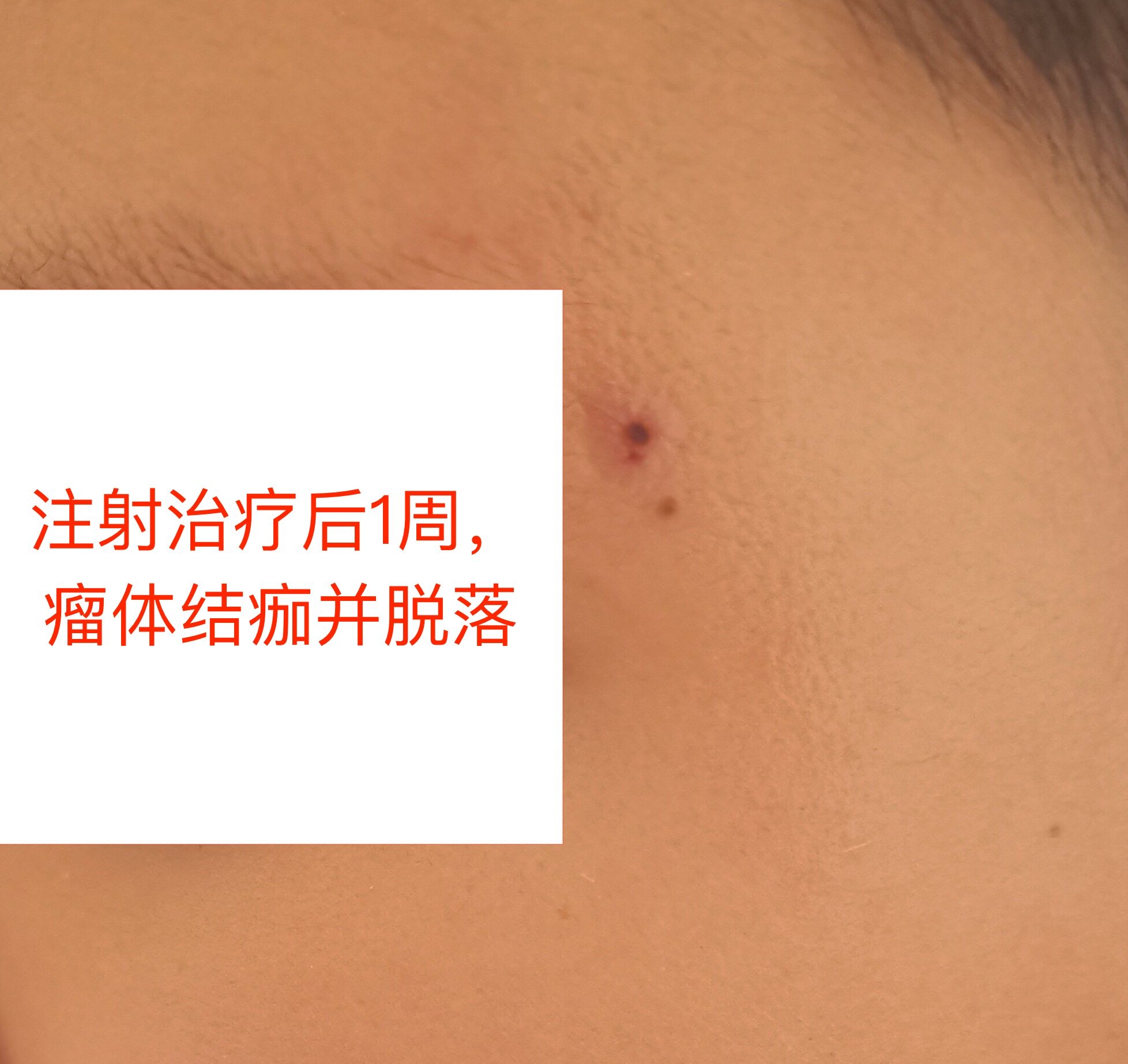 一例儿童的化脓性肉芽肿性血管瘤病例分享-门诊注射治疗安全有效 - 好