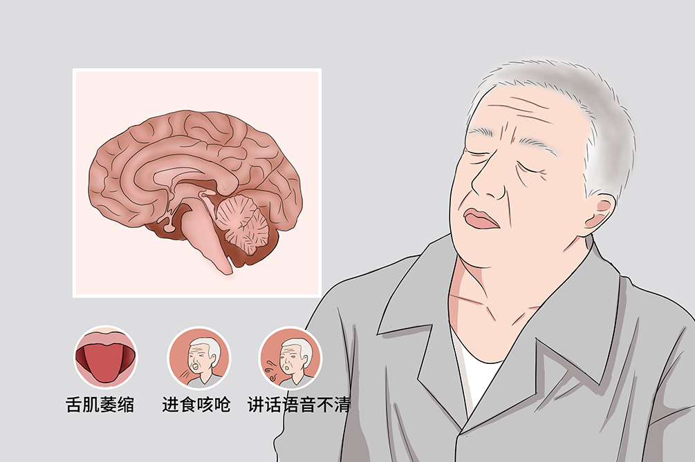 安军明主任医师针灸治疗进行性延髓麻痹一则 - 好大夫在线