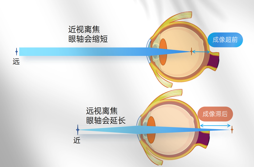 第二讲(4)近视的原因—缺乏光营养,成像滞后_近视_近视发病原因