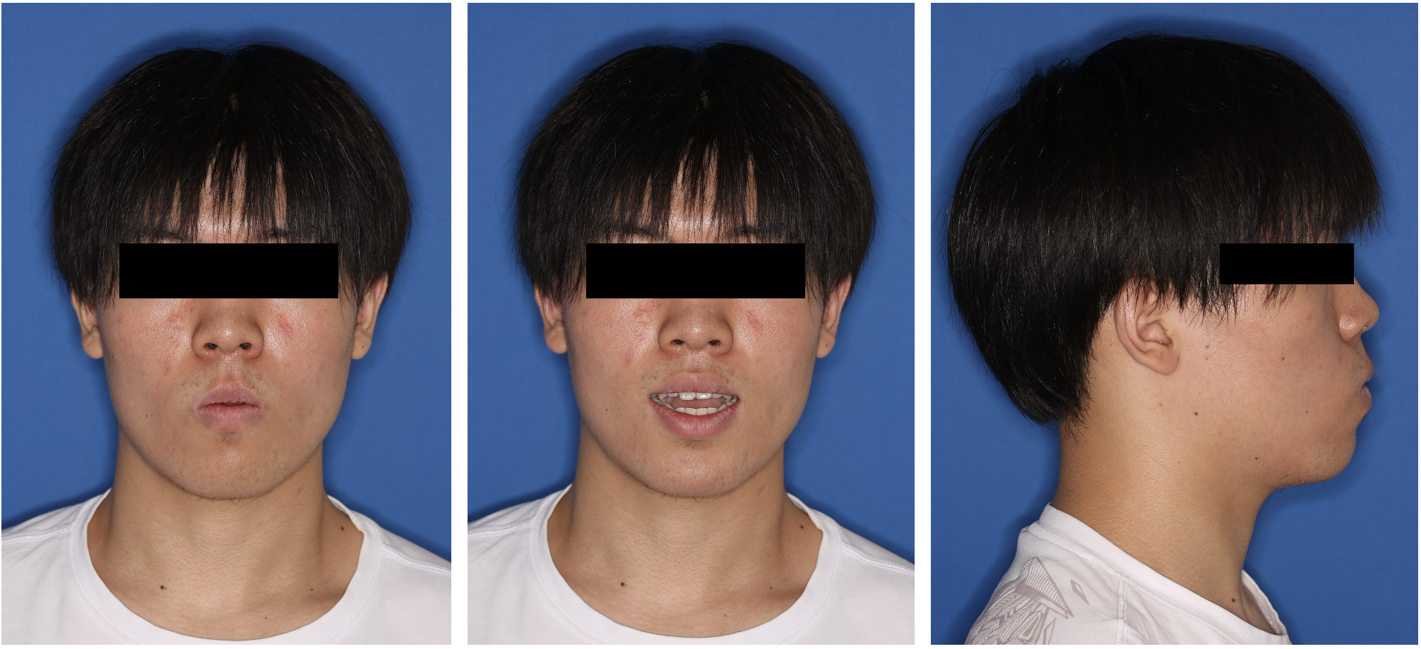 颞下颌关节骨关节病(tmjoa)相关前牙开合(aob)的正畸治疗方法 - 好大