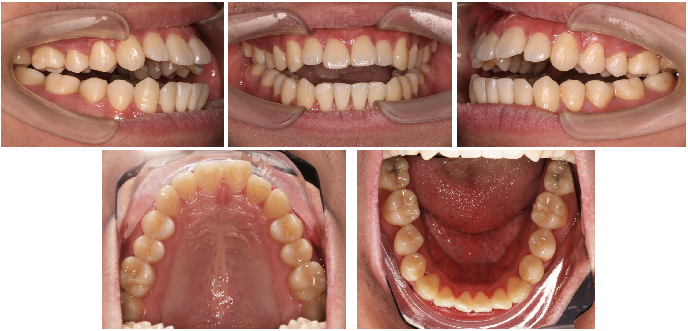 颞下颌关节骨关节病(tmjoa)相关前牙开合(aob)的