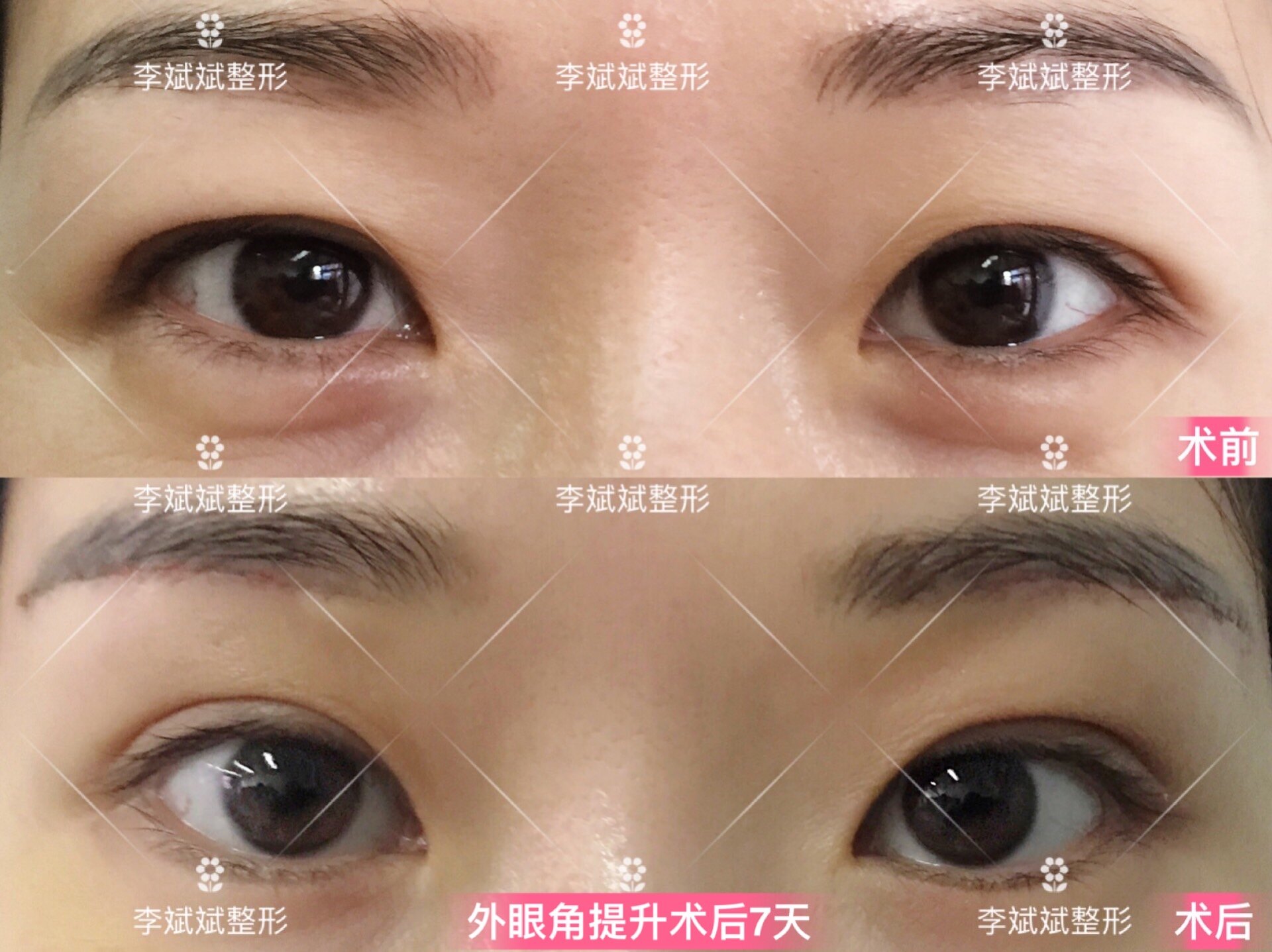 【外眼角提升】外眼角提升案例合集_眼部整形_眼部整形治疗介绍 - 好