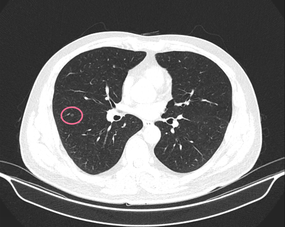 双肺多发小结节ct图片图片