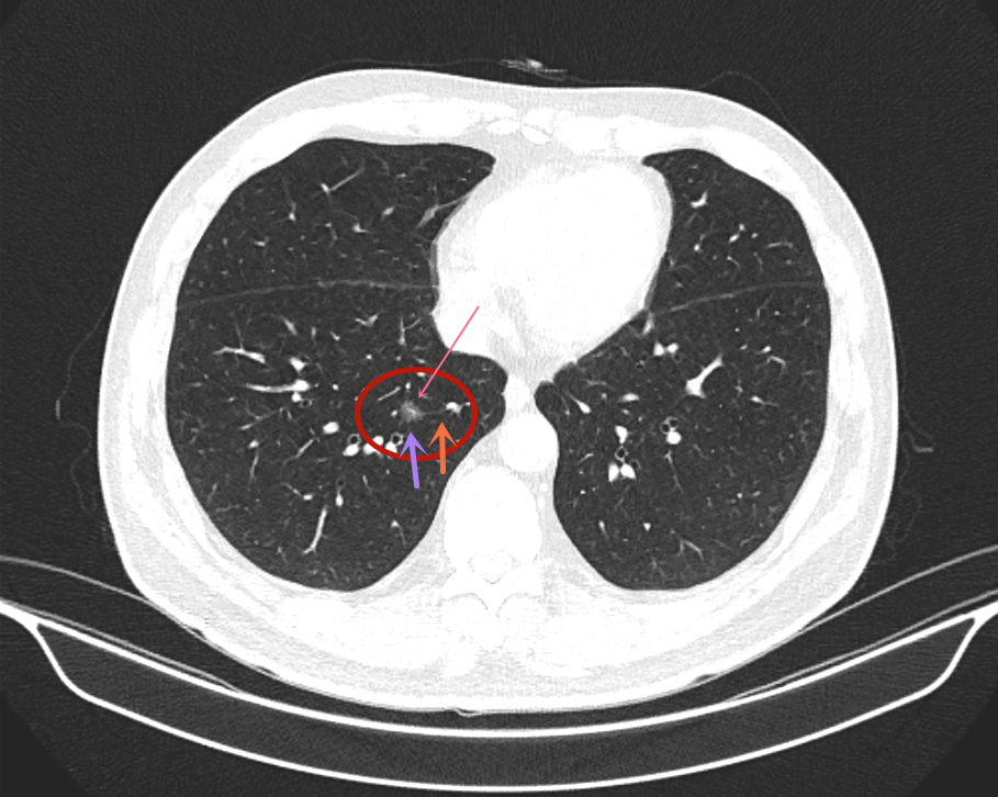 双肺多发小结节ct图片图片
