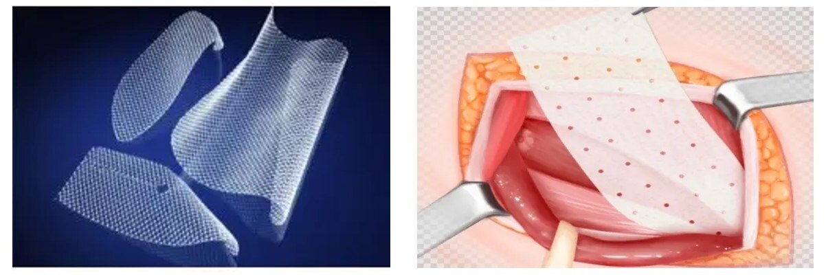 疝补片修补术图片