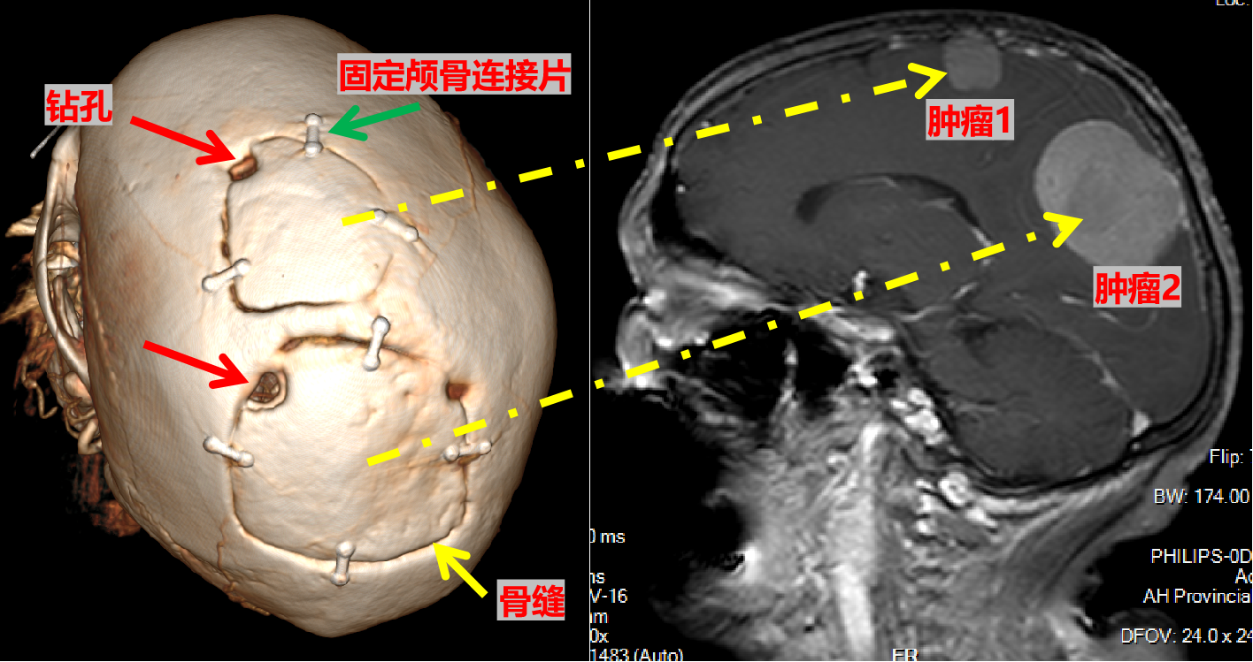 科普 开颅手术是怎么做的 掀开整个头盖骨吗 脑外伤 脑外伤治疗方式 好大夫在线 科普 开颅手术是怎么做的 掀开整个头盖骨吗 脑外伤 脑外伤治疗方式 好大夫在线